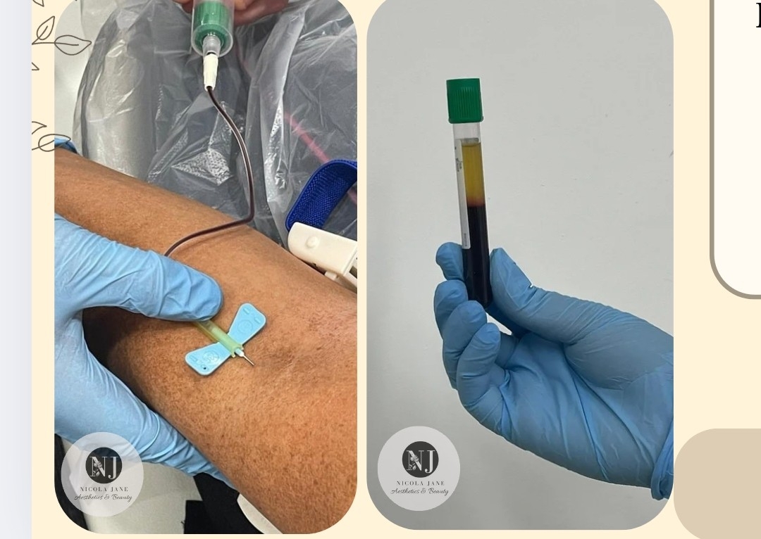 PRP under eye injections 