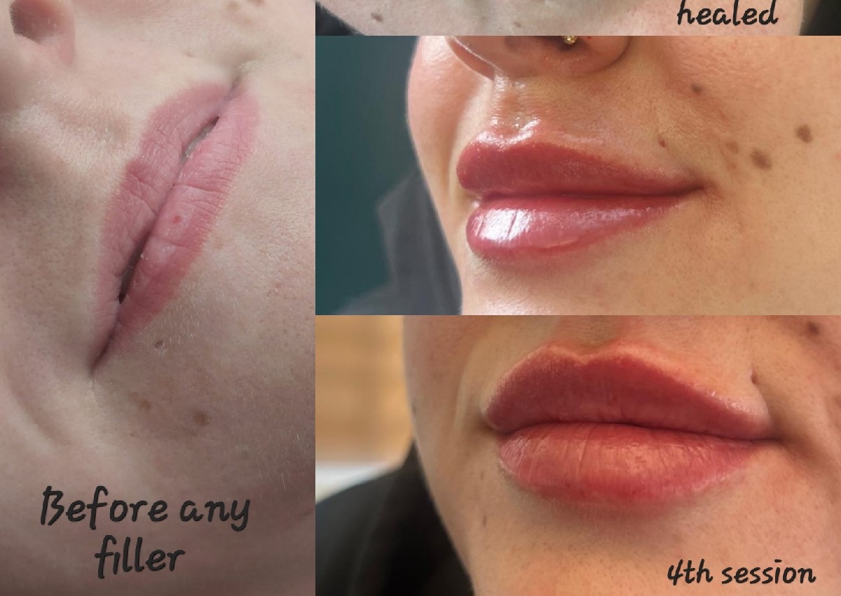 Lip Filler 1.1ml 💋 
