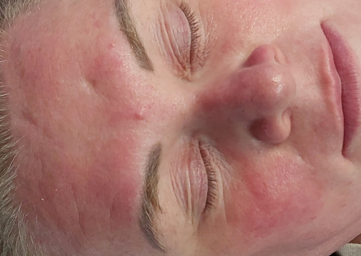 Chemical Peel 