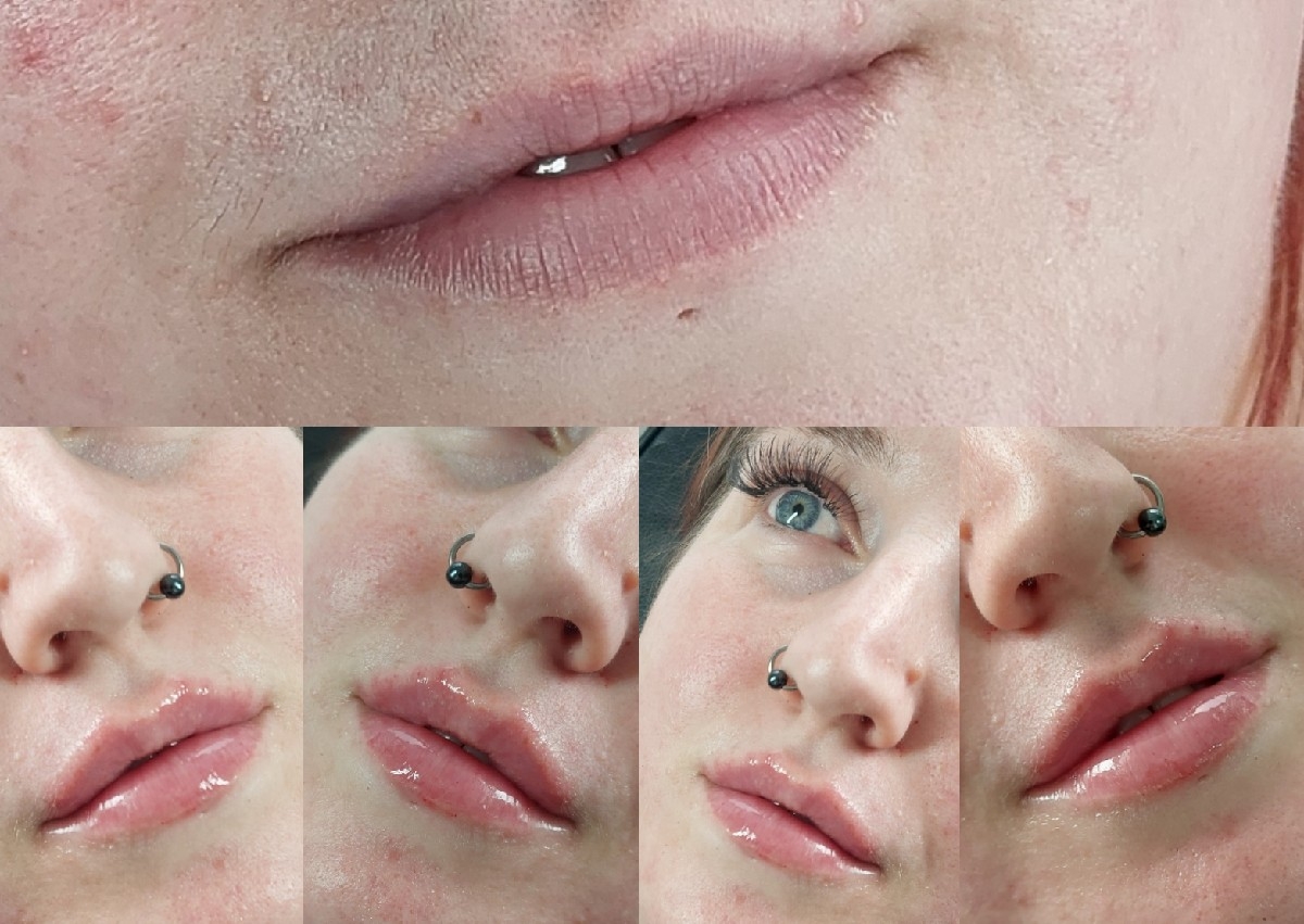Lip Filler 0.5 ml 💋 