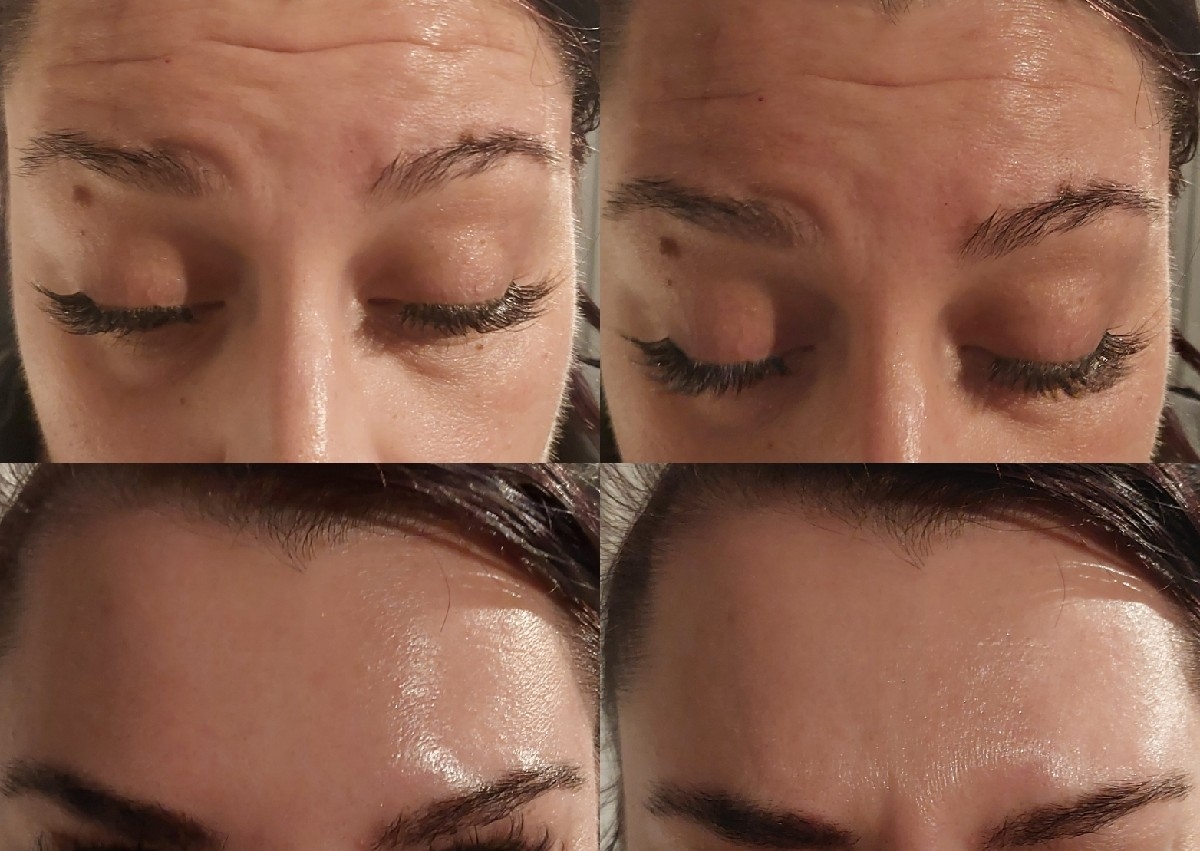 Antiwrinkle injections 3 areas 