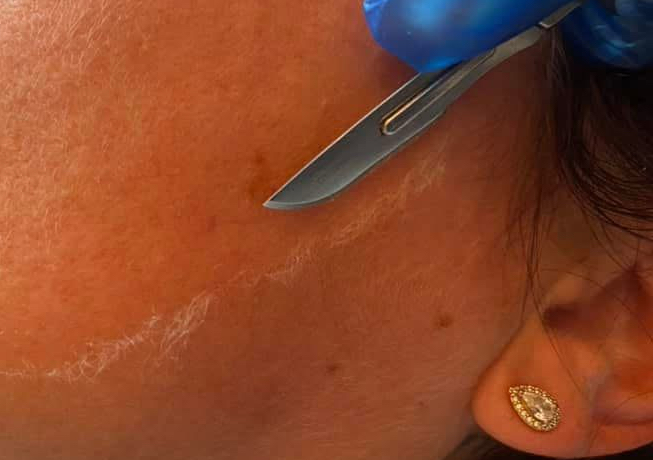 Dermaplan Facial Training