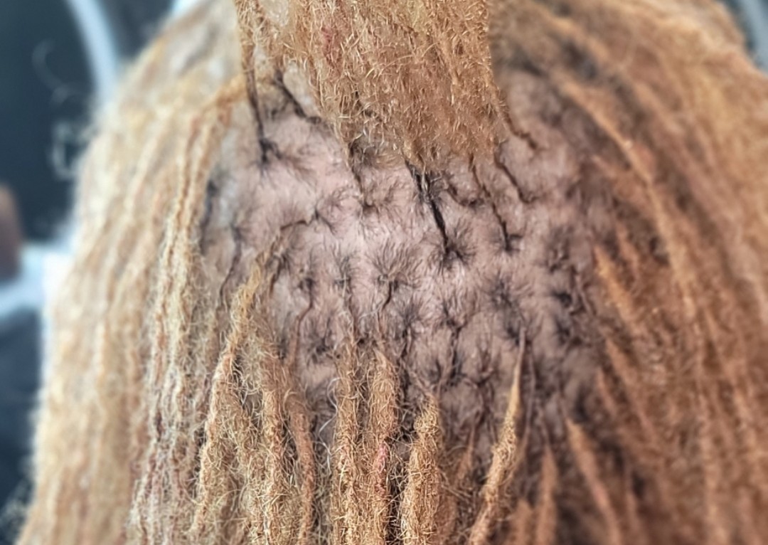 Micro'LOCS RETIGHTENING  (2/2)