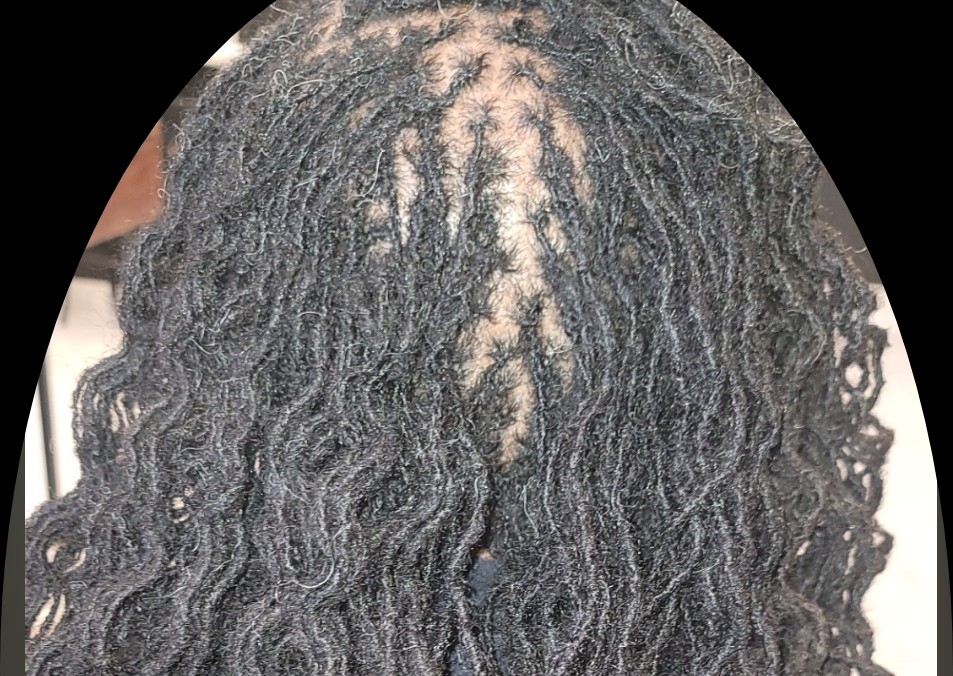 Micro'LOCS RETIGHTENING 