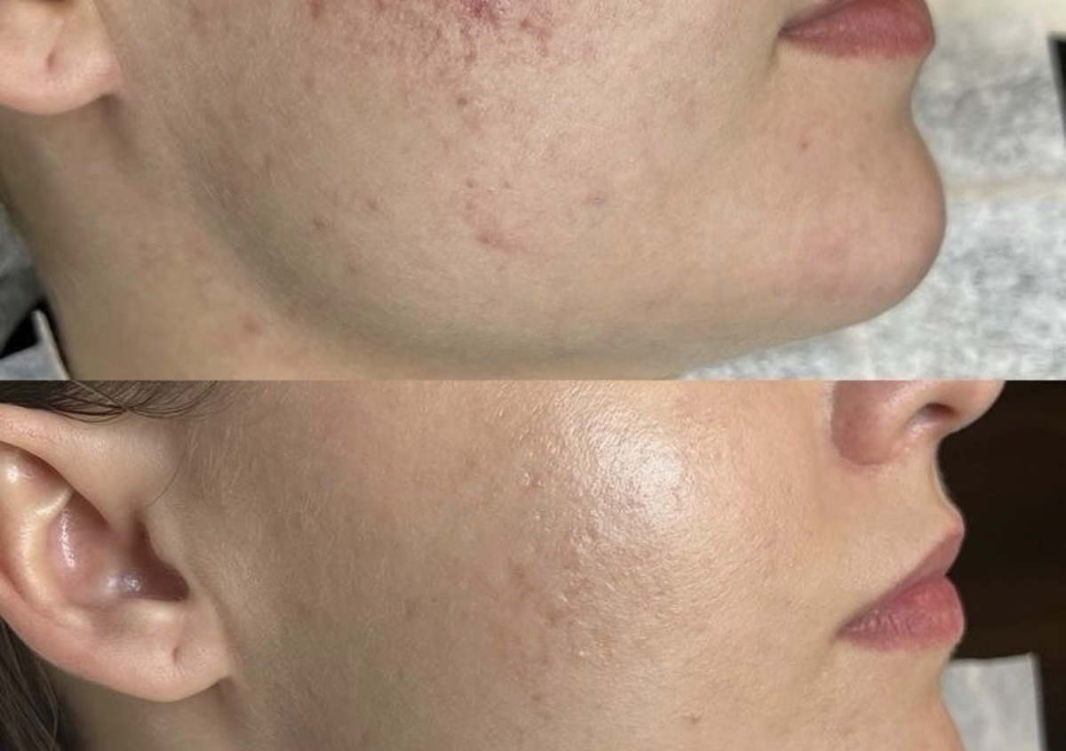 Custom facial