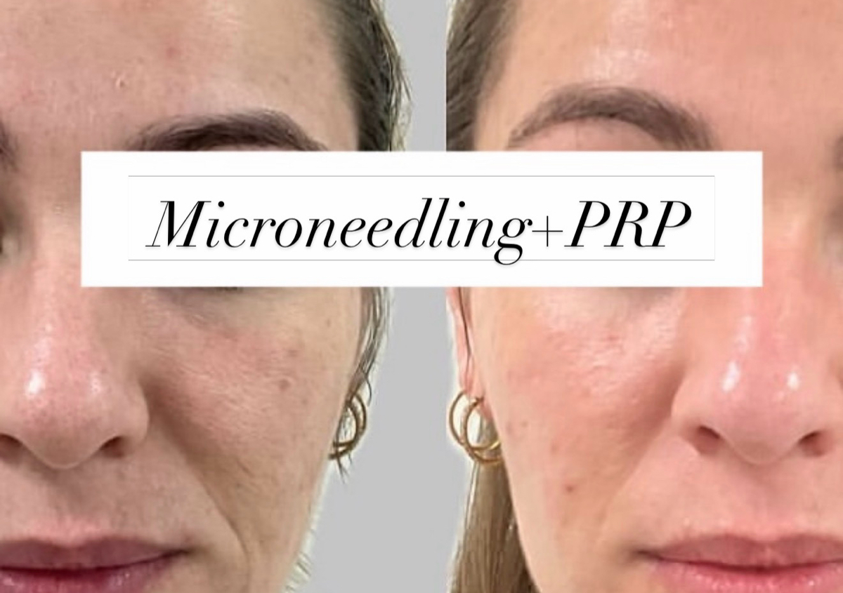 Microneedling 