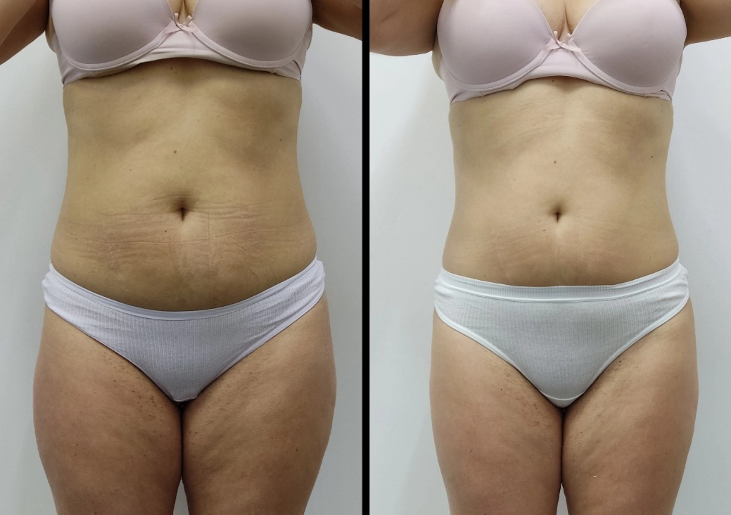 Body contouring 