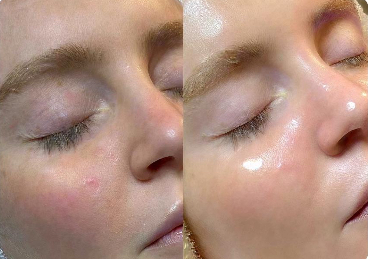 Hydrafacial 