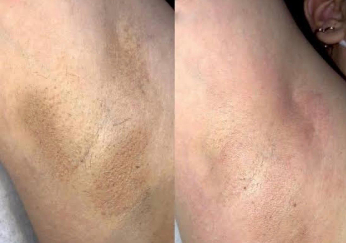 Aclaramiento corporal de Axilas (3 sesiones)
