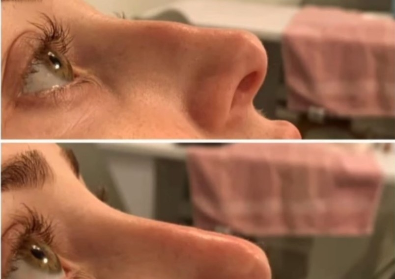 Nose Augmentation 