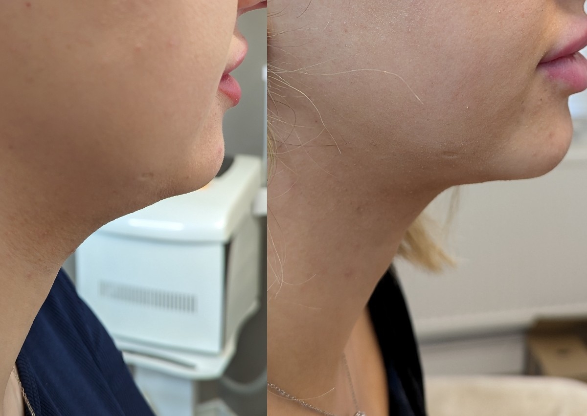 Lemon Bottle fat dissolving chin