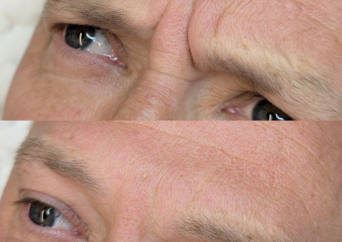 Anti wrinkle one area