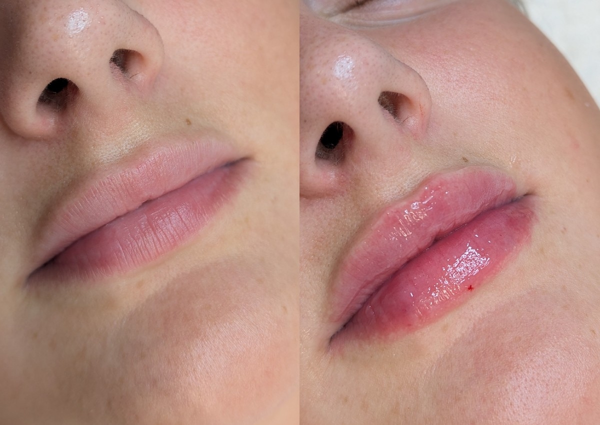 Dermal filler 0.5