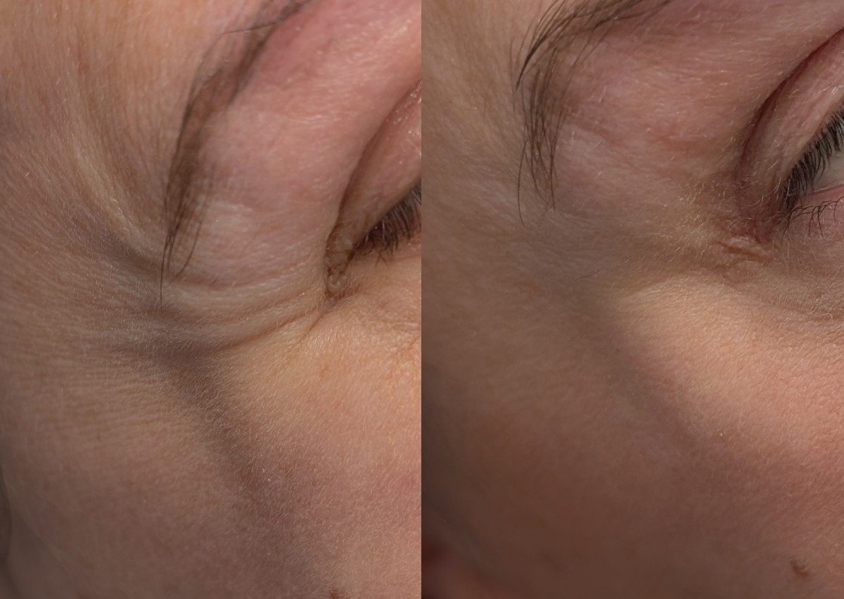Anti wrinkle three area's