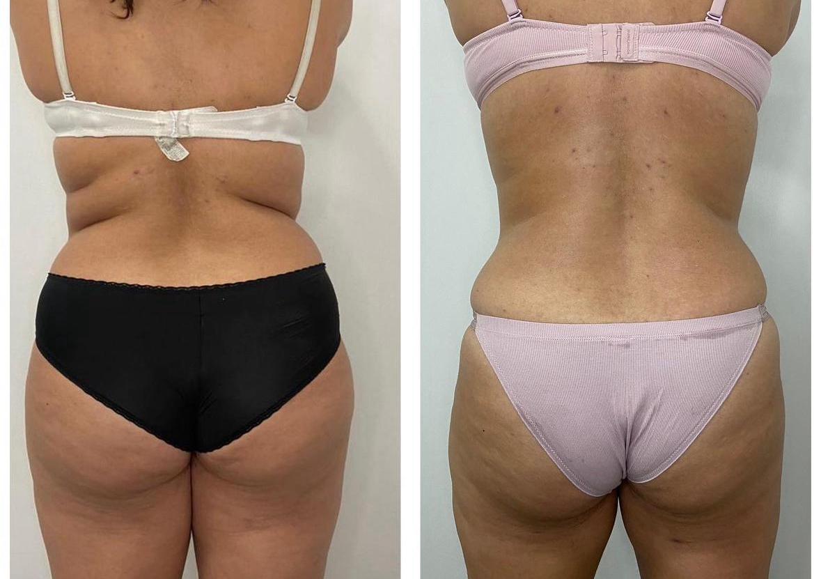 Maderoterapia corporal 