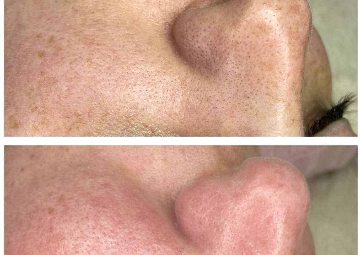 Higiene facial profunda 