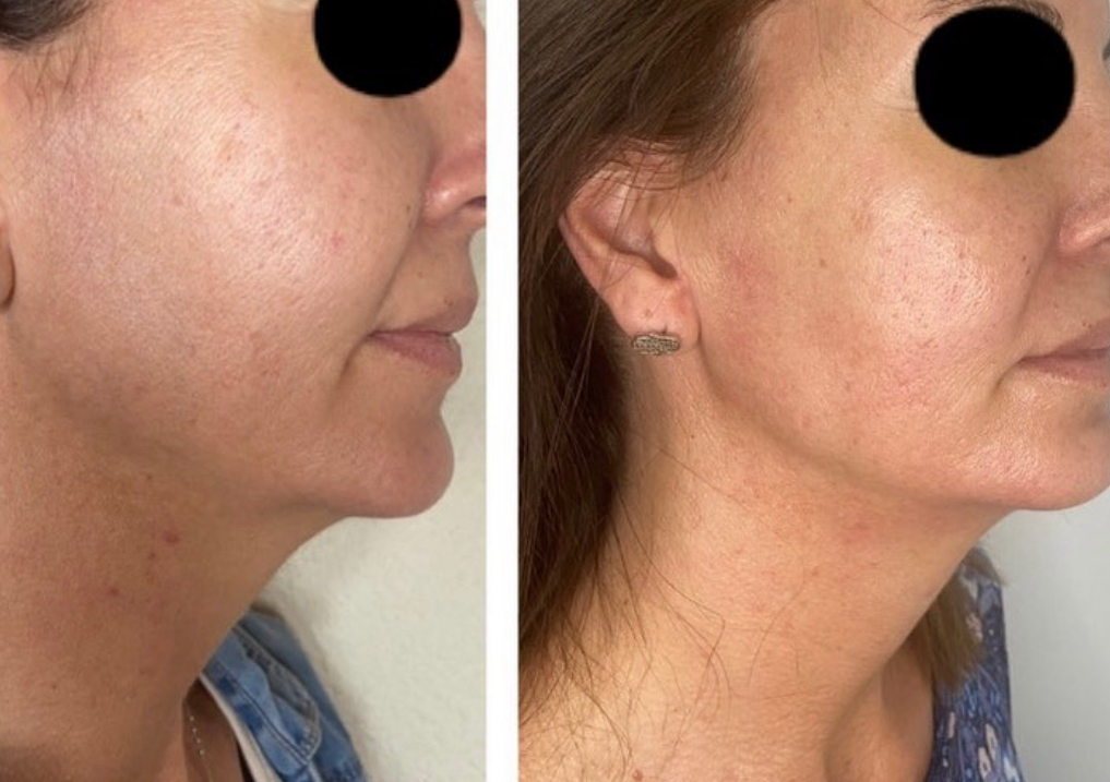 Maderoterapia facial 