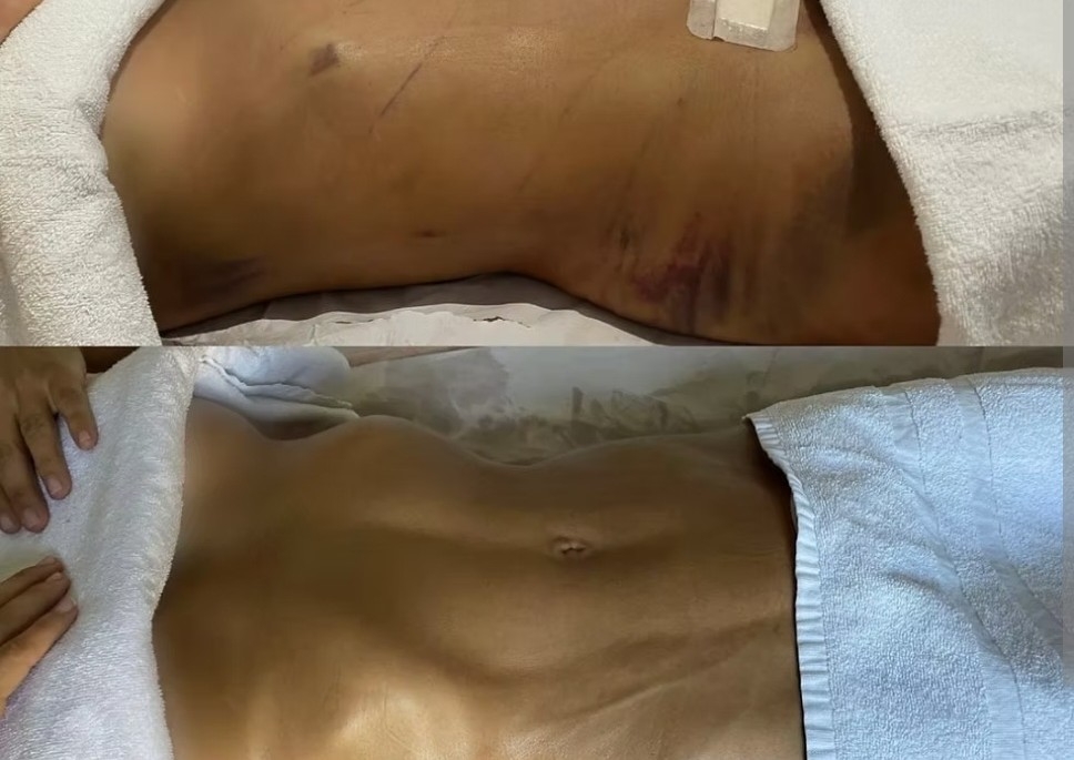 Drenaje linfatico/Post Operatorio 