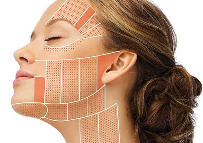 HIFU Rostro & Escote 