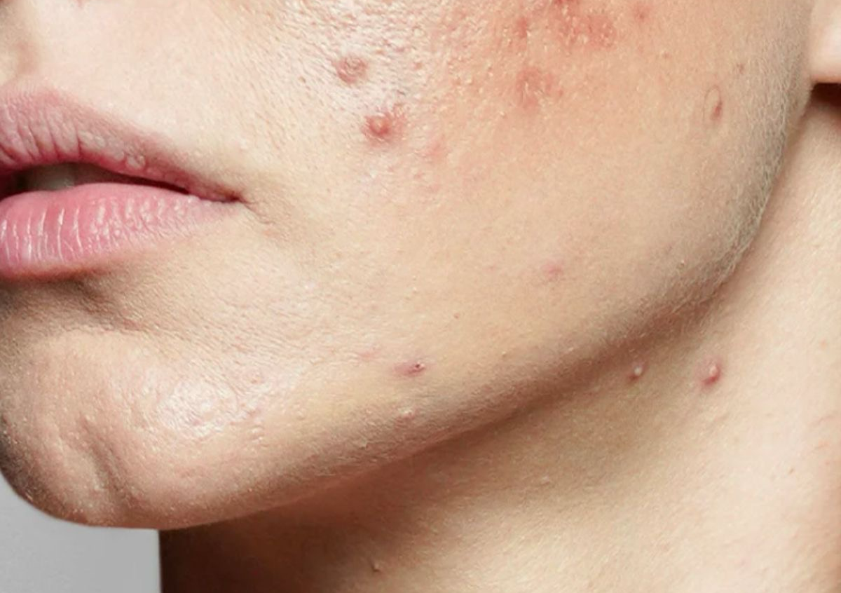 Antioxidant Acné  Prone Skin Treatment 