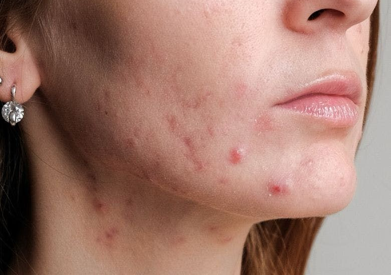 Antioxidant Acné Treatment (Rostro y Escote)