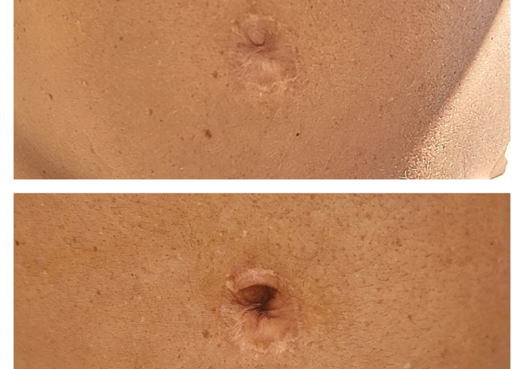 3D belly button 