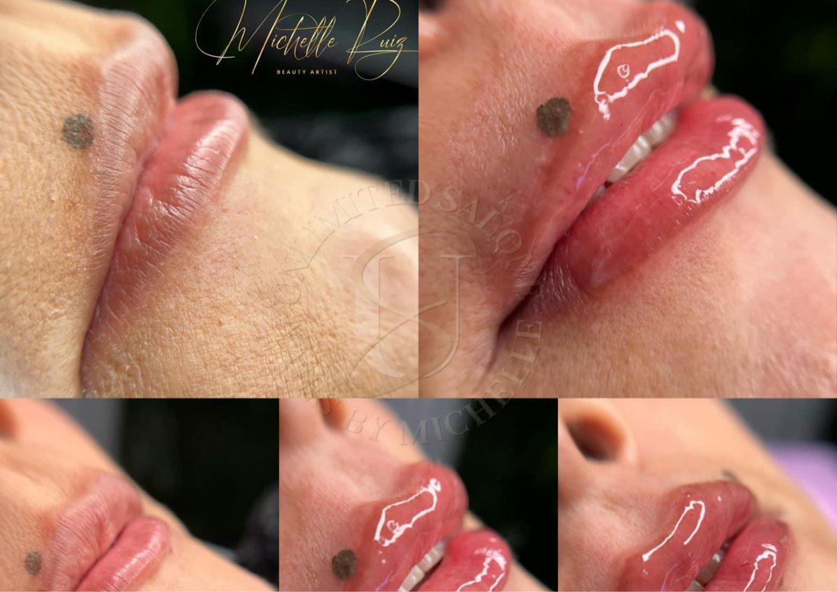 Aumento de Labios 1ML