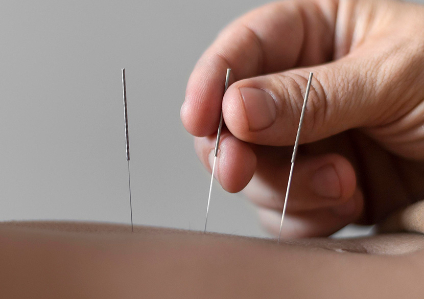 Acupuncture