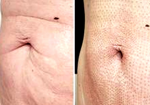 Plasma Pen en el cuerpo