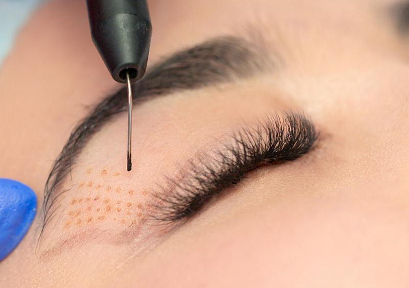 Plasma pen en el rostro 