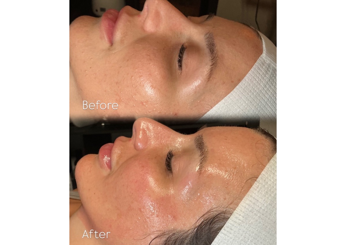 Corrective Peel Series