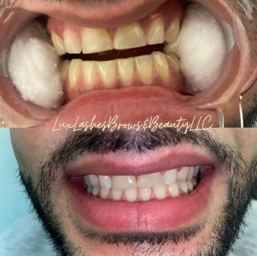 Teeth Whitening 