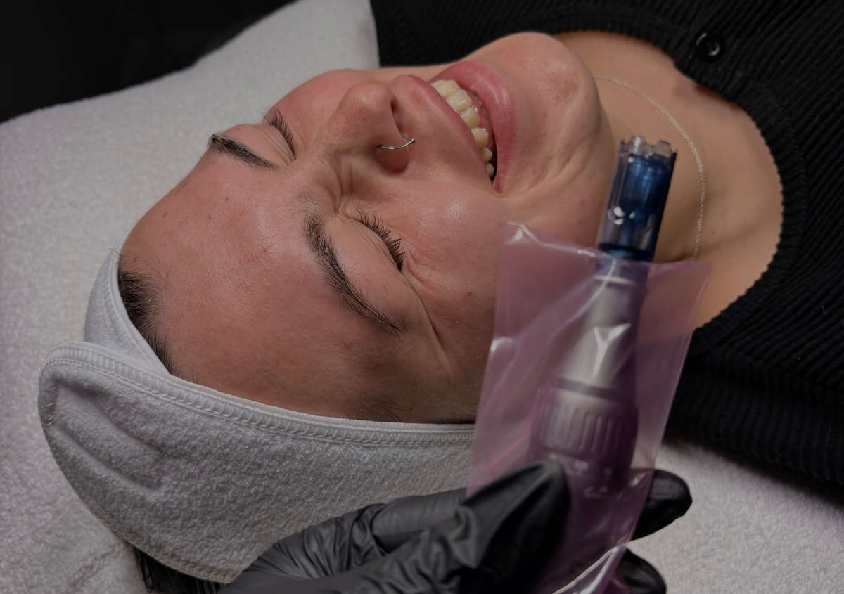  Microneedling  (1 session) | StudioSkin