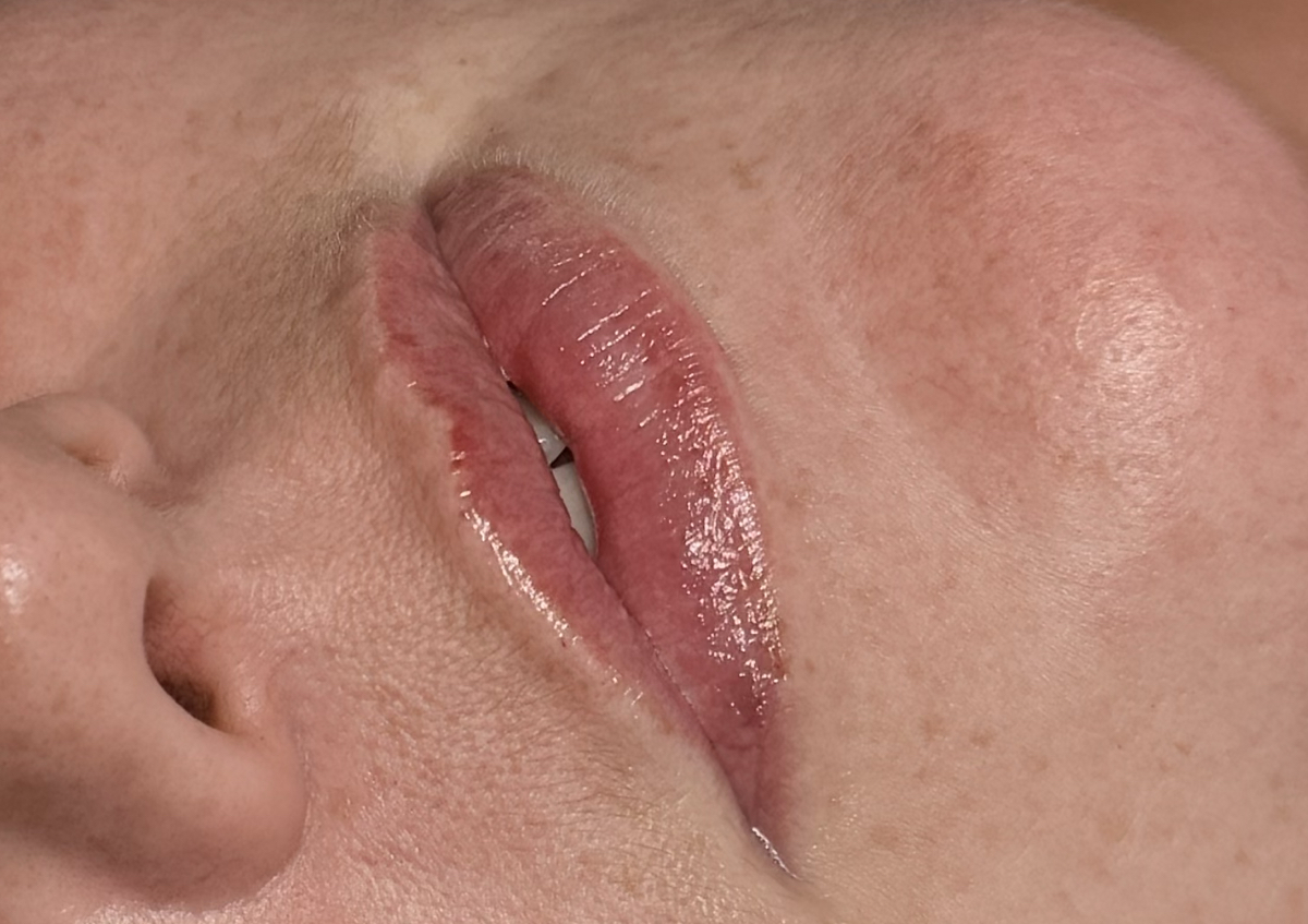 Lip Filler  (4/4)