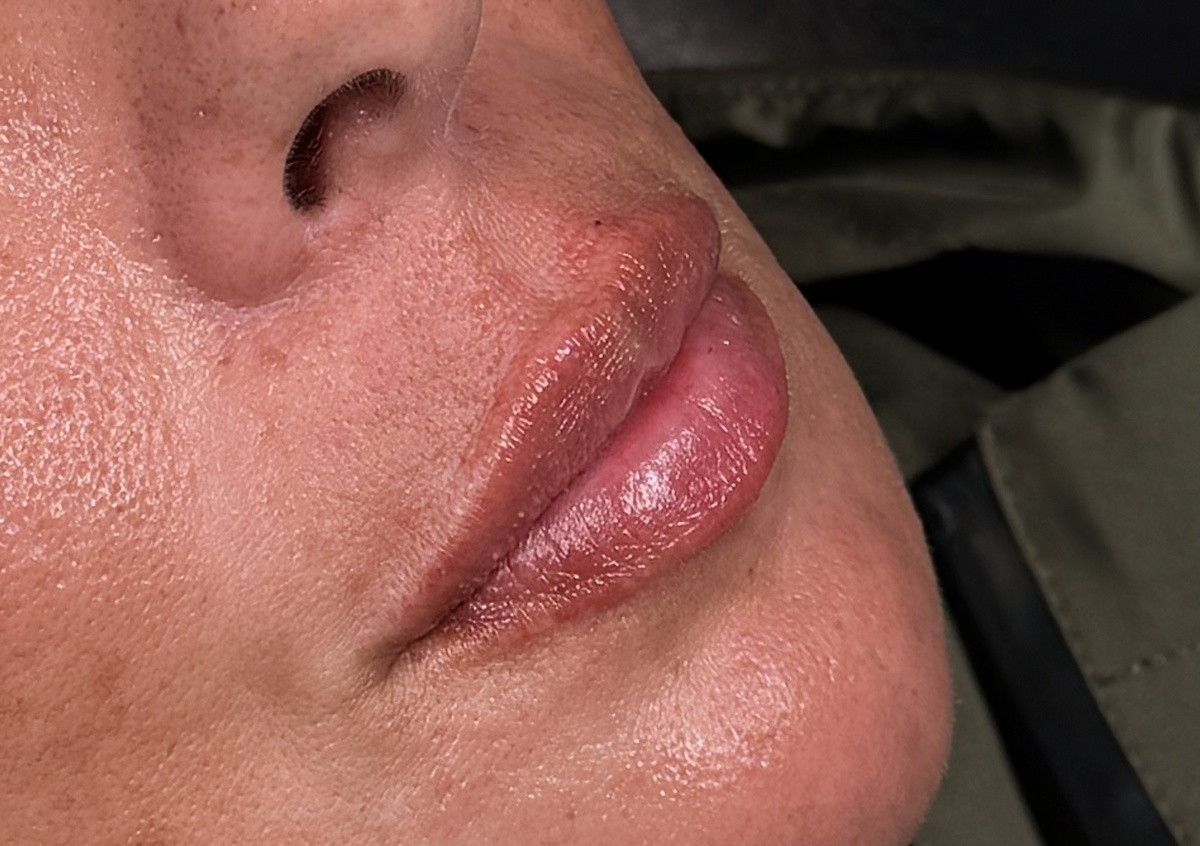 Lip Filler  (2/4)