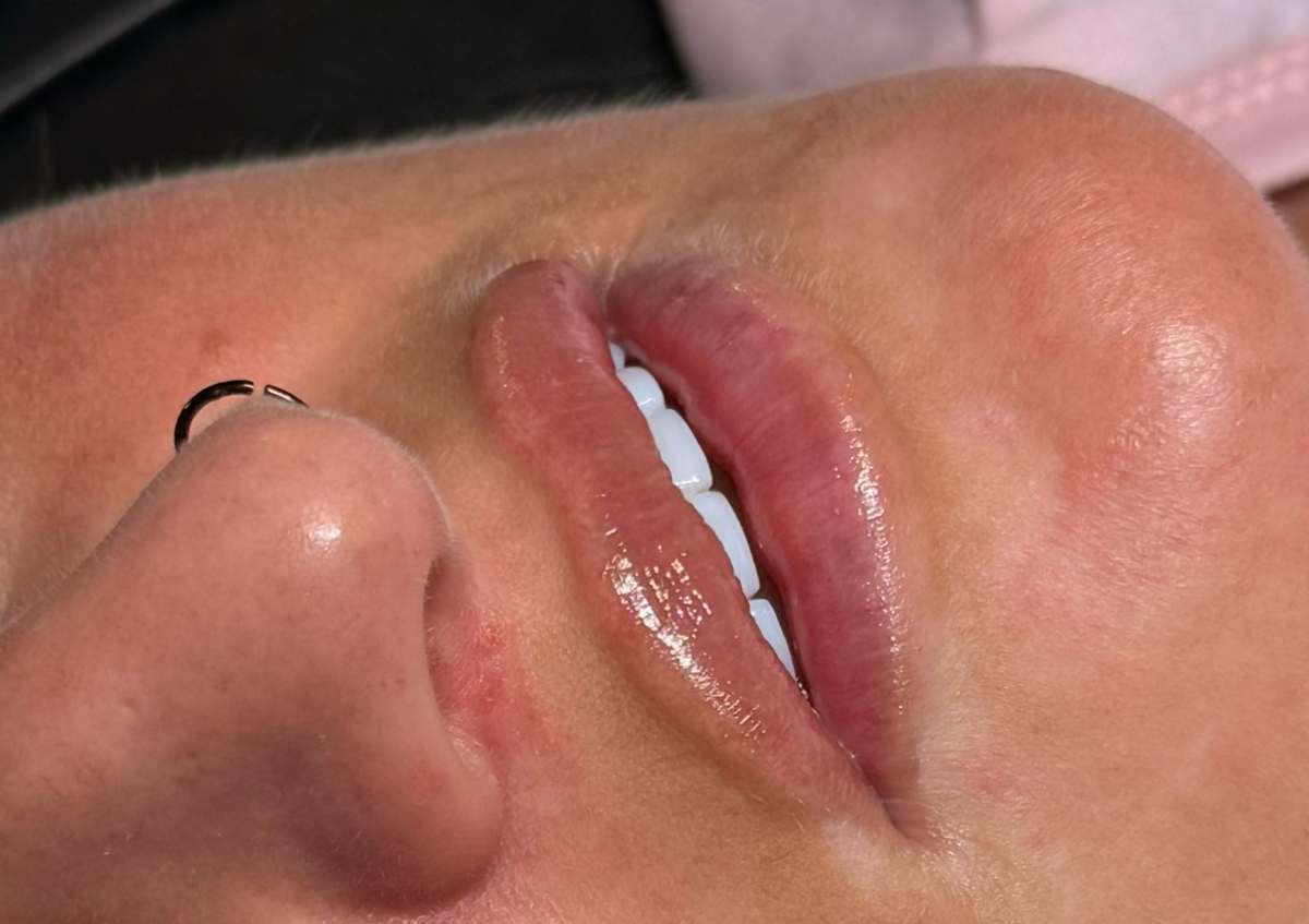 Lip Filler  (3/4)