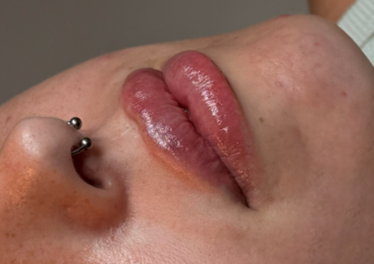 Lip Filler  (1/4)