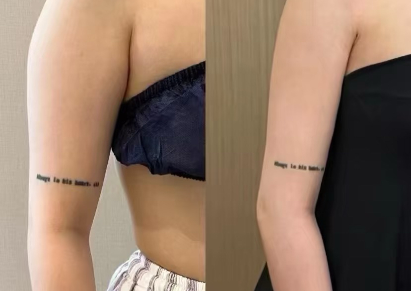 Arm Slimming Burn Fat injection 