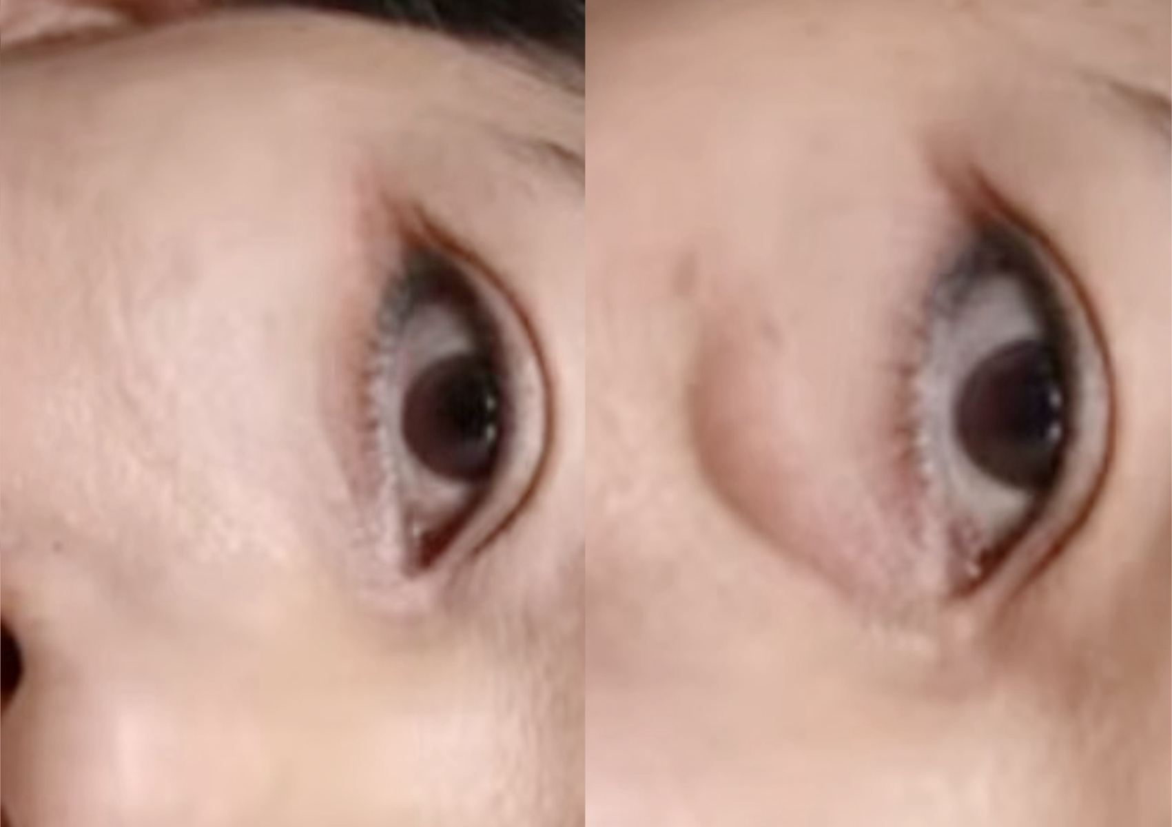 Eyebag Remove-by Doctor
