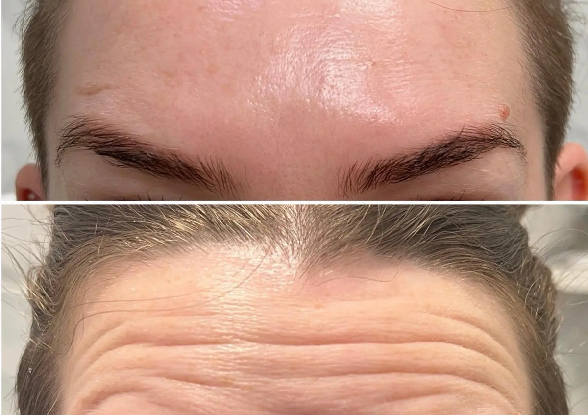 Forehead Wrinkles botox