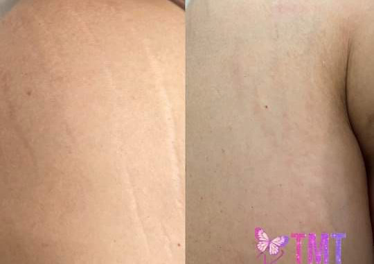 INKLESS  Stretch Mark Camouflage