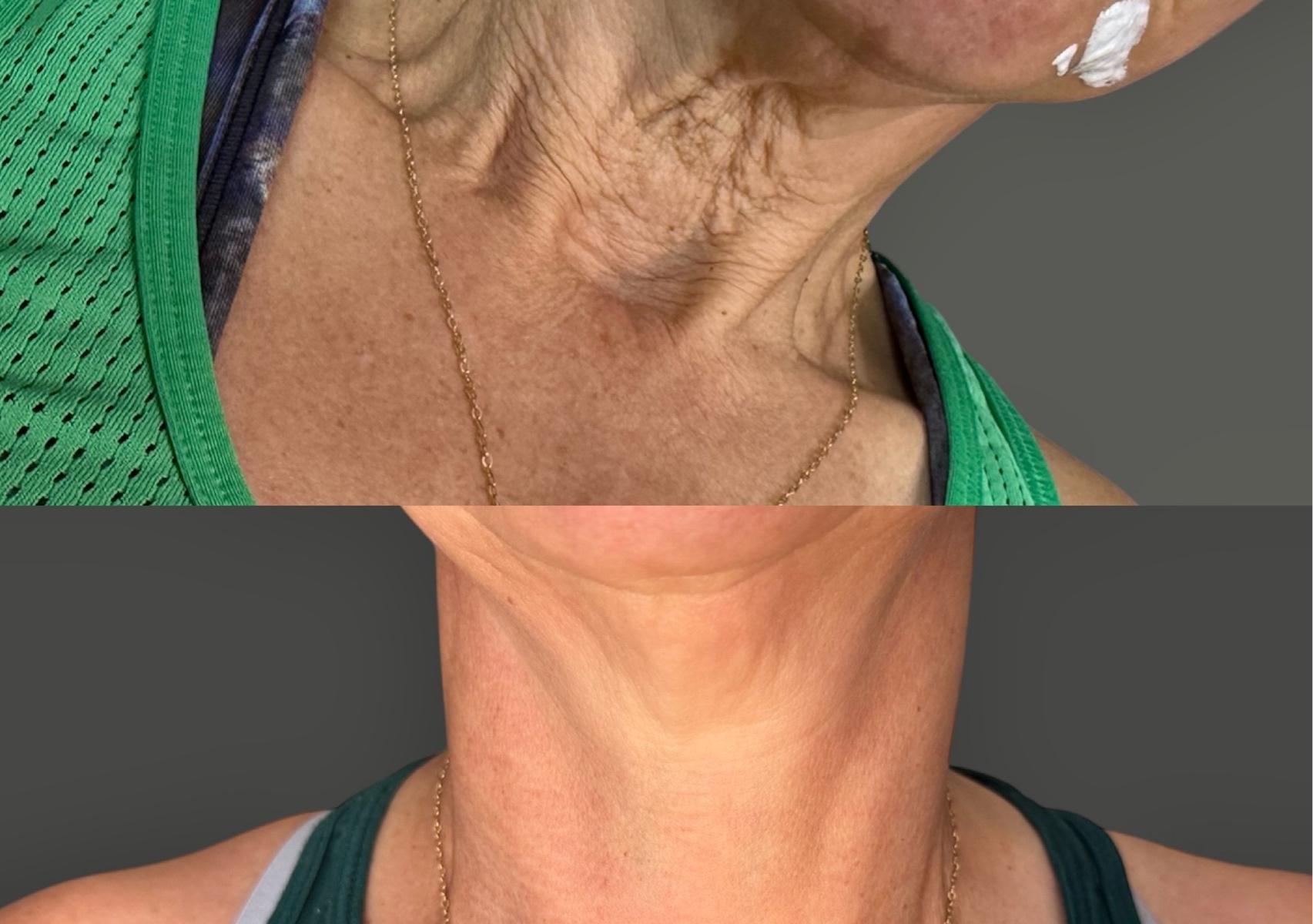 Neck Firming Derma 2.0