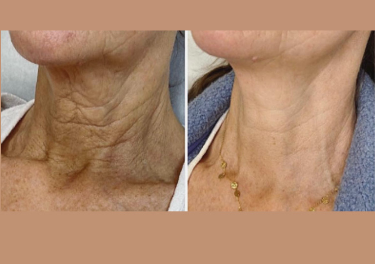 Neck & Face Skin Booster 