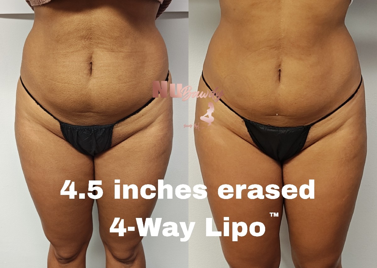 4-Way Lipo 8 Session Special 