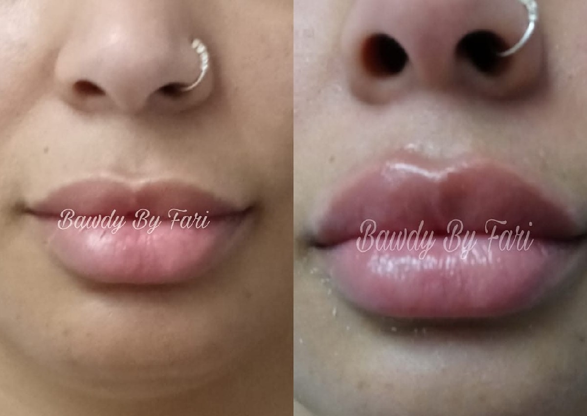 1 ml Lip Infusion Special 