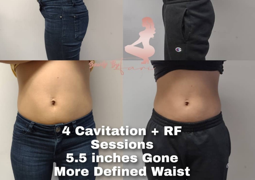 4 Sessions - Cavitation & Radio Frequency