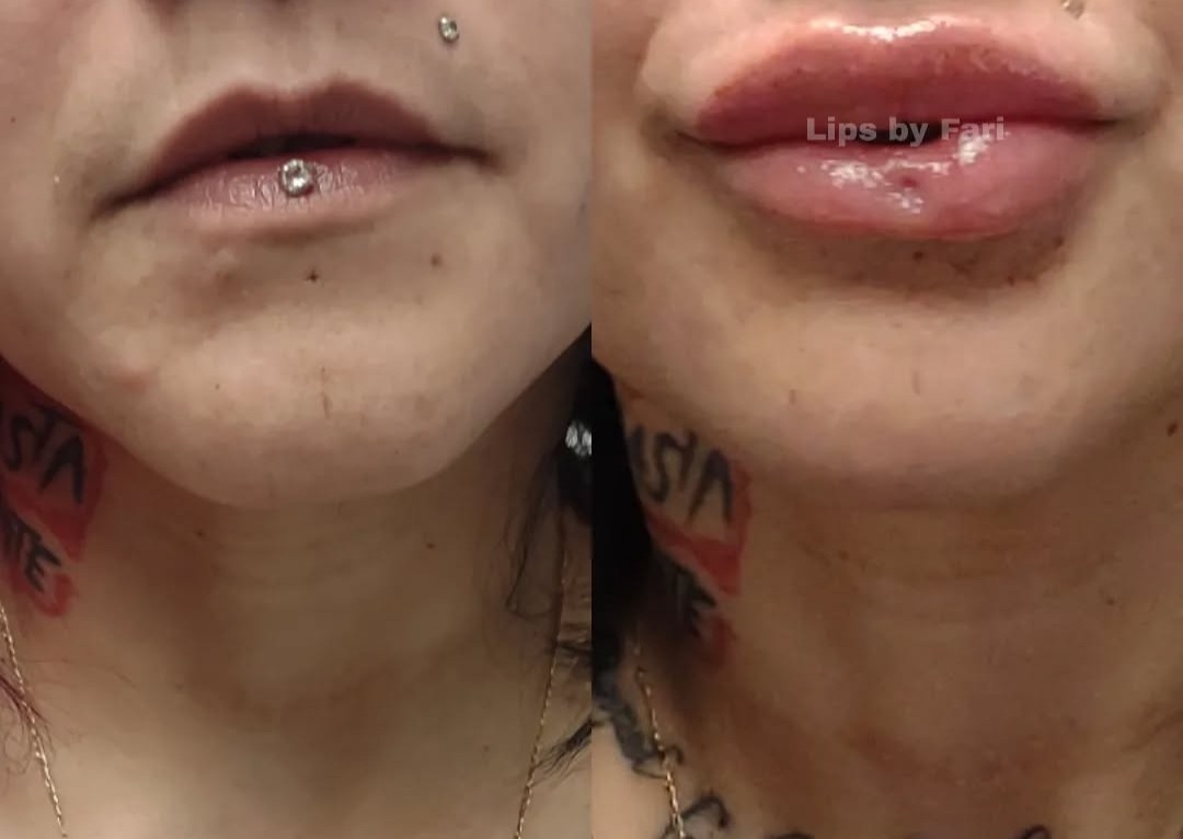 2 ml Needleless Lip Infusion