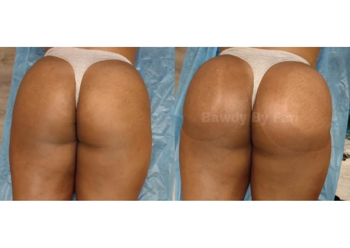 6 CBL (Colombian Butt Lift)