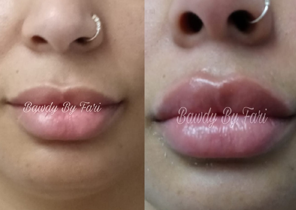 2 ml Lip Infusion Special 