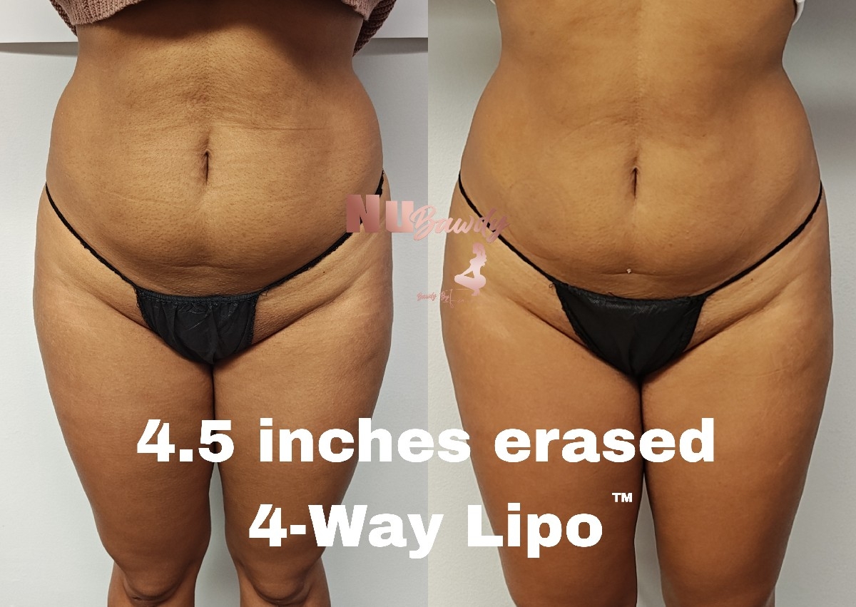4-Way Lipo (1 Session)